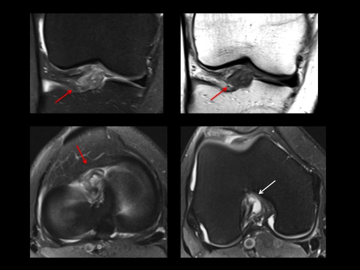 Figure 2 for case anterior cruciate ligament ( RID2781 )